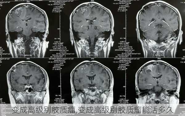 变成高级别胶质瘤,变成高级别胶质瘤能活多久