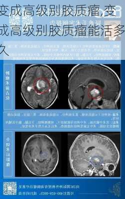 变成高级别胶质瘤,变成高级别胶质瘤能活多久